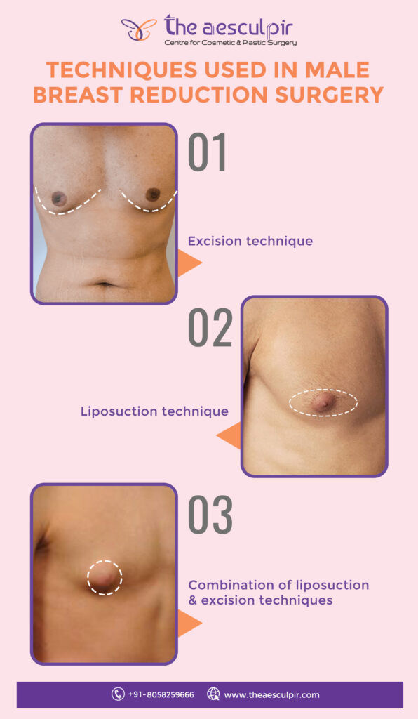 Male Breast Reduction Surgery Techniques / Aesculpir Clinic  