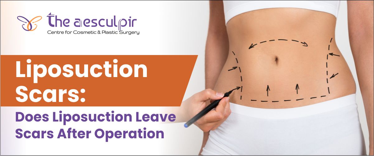 Liposuction_scars