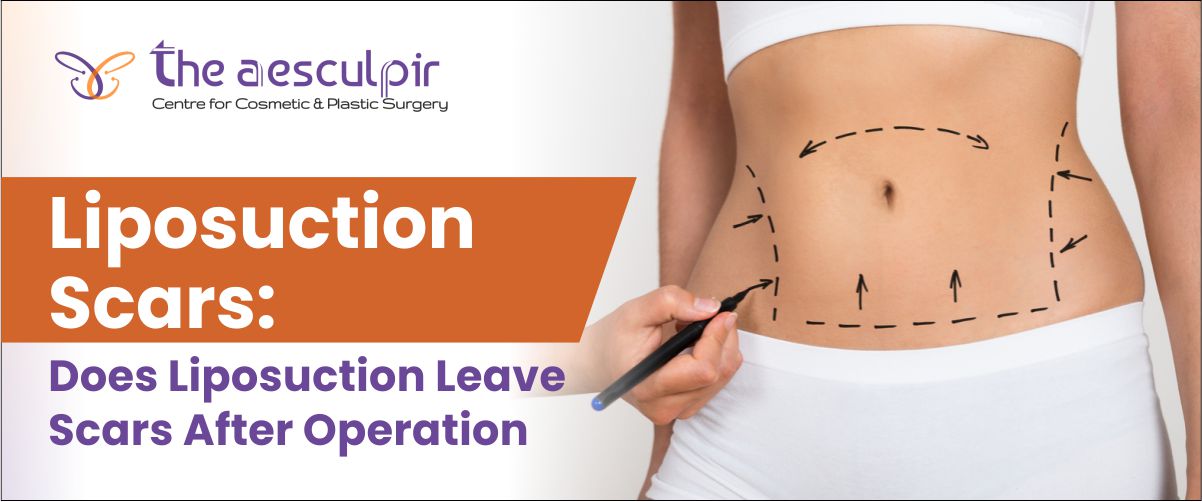 Liposuction_scars