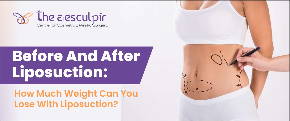 weight-loss-with-liposuction