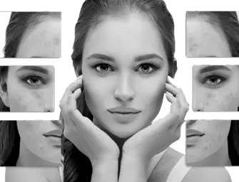 Best Acne Treatment in Delhi