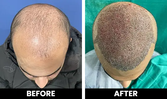Rhinoplasty Before After