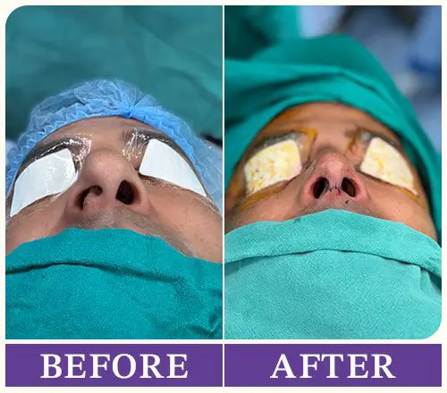 Before After Hairtransplant