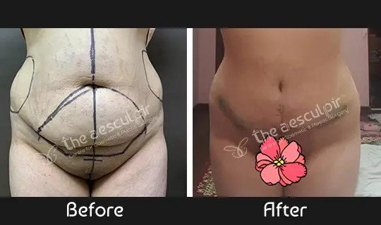 abdominoplasty