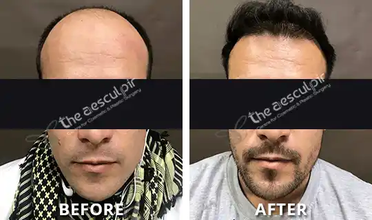 Before After Hairtransplant