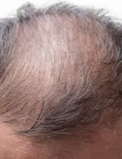 HAIR TRANSPLANT