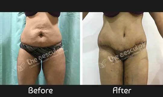 abdominoplasty