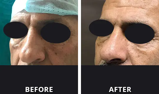 rhinoplasty