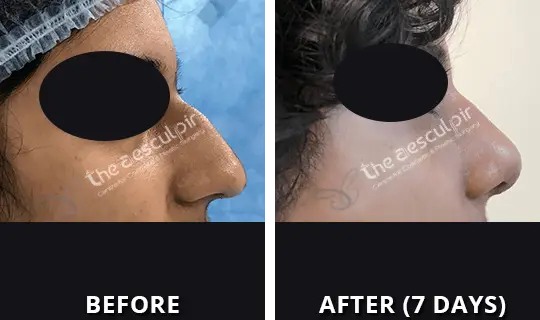 rhinoplasty