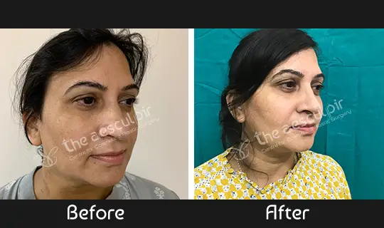 rhinoplasty